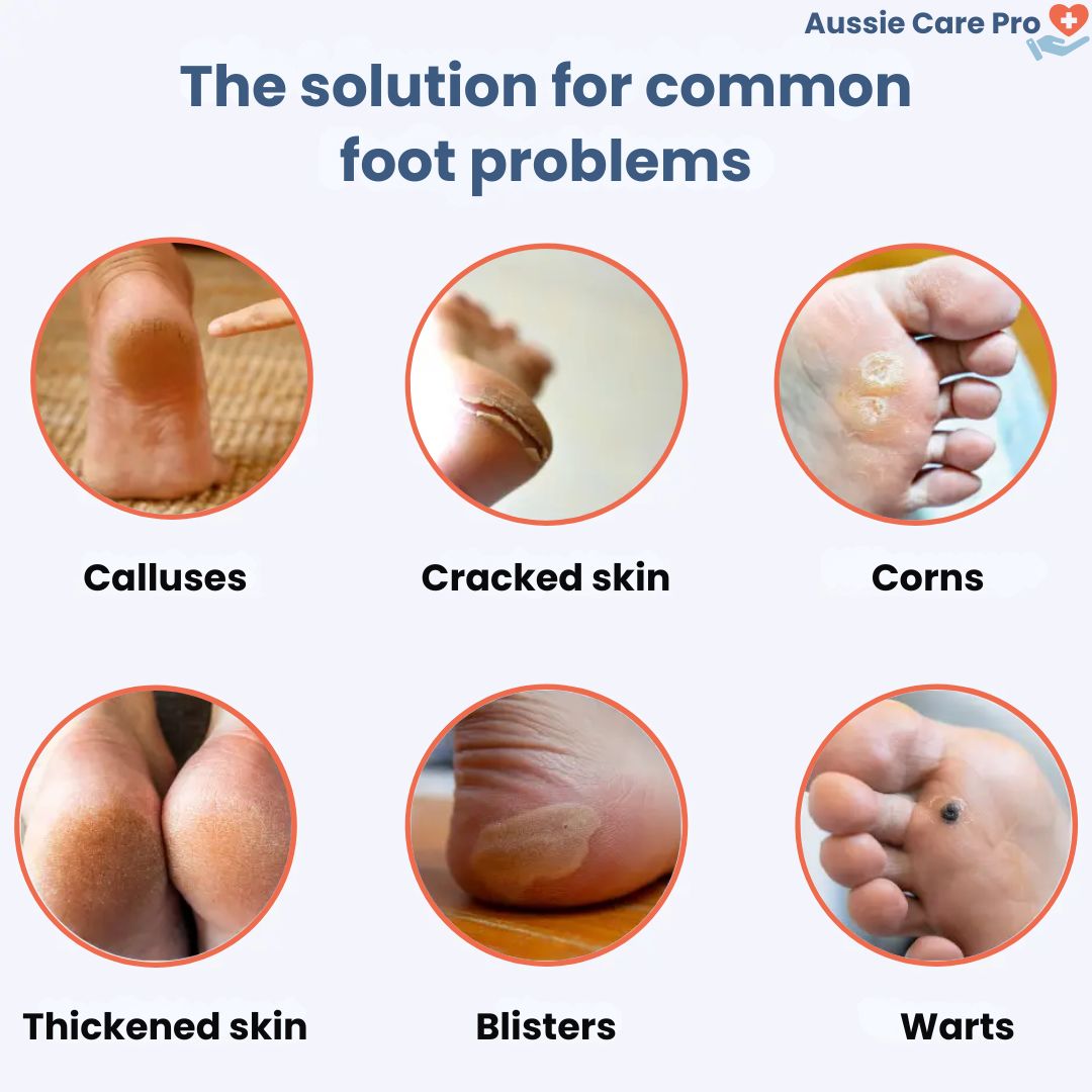 Electric Callus and Hard Skin Remover